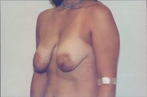 Breast Lift Patient 12 - Before - 2 Thumbnail