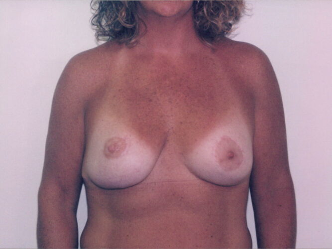 Breast Lift Patient 11 - After - 1