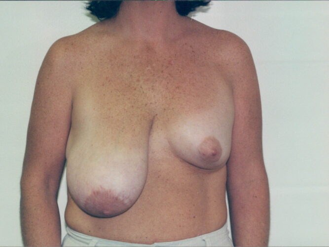 Breast Lift Patient 11 - Before - 1