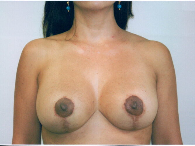 Breast Lift Patient 10 - After - 1