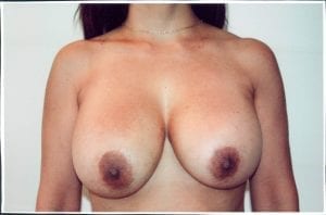Breast Lift Patient 10 - Before - 1 Thumbnail