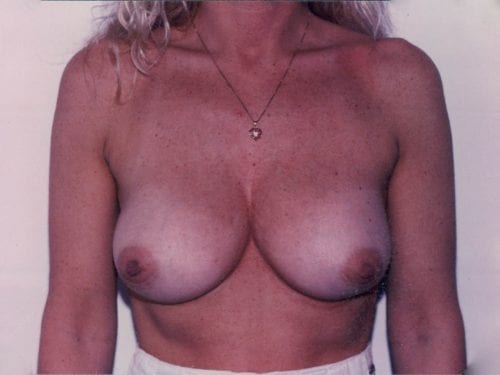 breast lift implants 1 000521