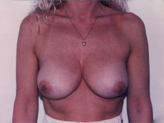 Breast Lift with Implants Patient 01 - Before - 1