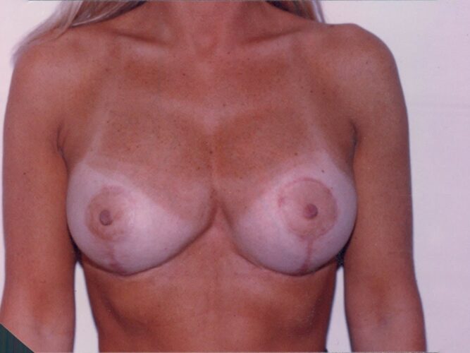 Breast Lift with Implants Patient 01 - After - 1