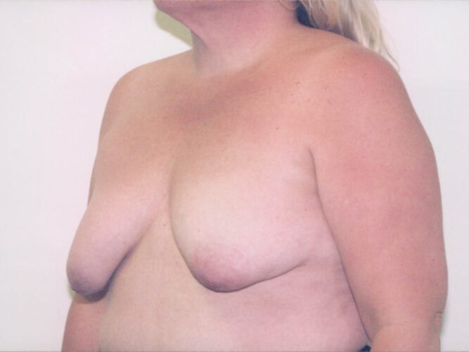 Breast Lift with Implants Patient 02 - Before - 1