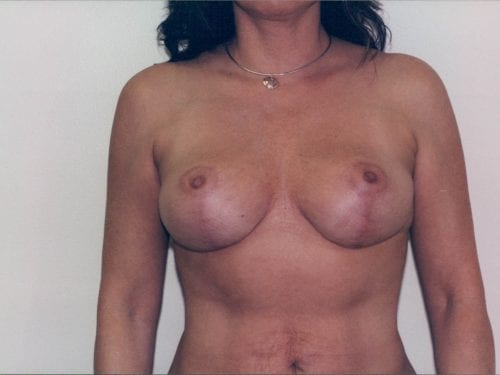 breast lift implants 1 00094