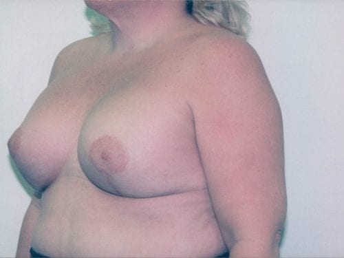 breast lift implants 1 001020