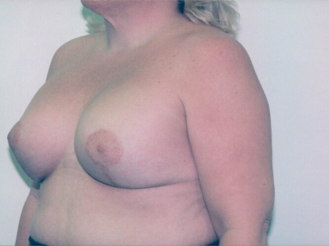 Breast Lift with Implants Patient 02 - After - 1