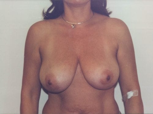breast lift implants 1 00104