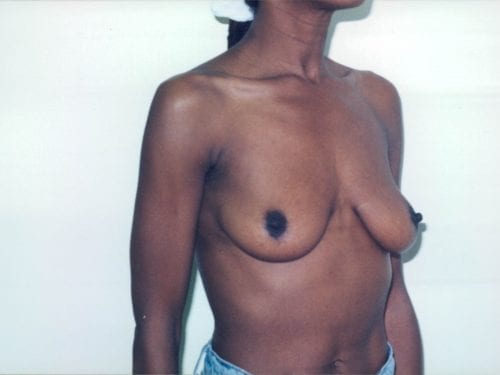 breast lift implants 1 00164