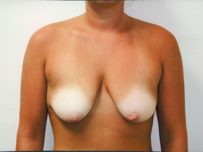 Breast Lift with Implants Patient 08 - Before - 1