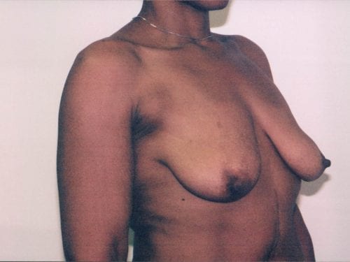 Breast Lift with Implants Patient 09 - Before - 1