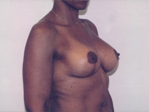 Breast Lift with Implants Patient 09 - After - 1