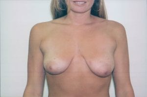 Breast Lift with Implants Patient 10 - Before - 1 Thumbnail