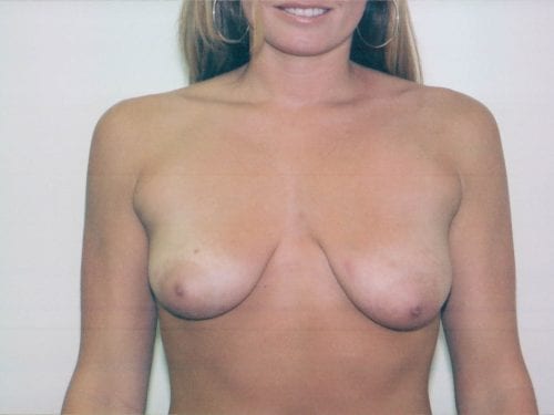 breast lift implants 1 00294
