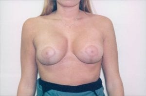 Breast Lift with Implants Patient 10 - After - 1 Thumbnail