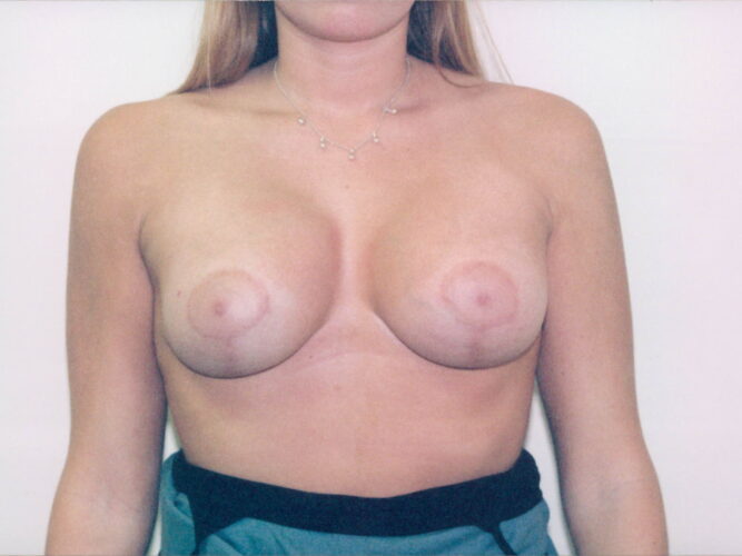 Breast Lift with Implants Patient 10 - After - 1