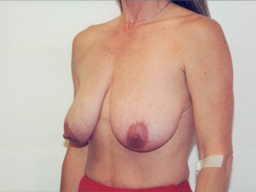 breast lift implants 1 00333