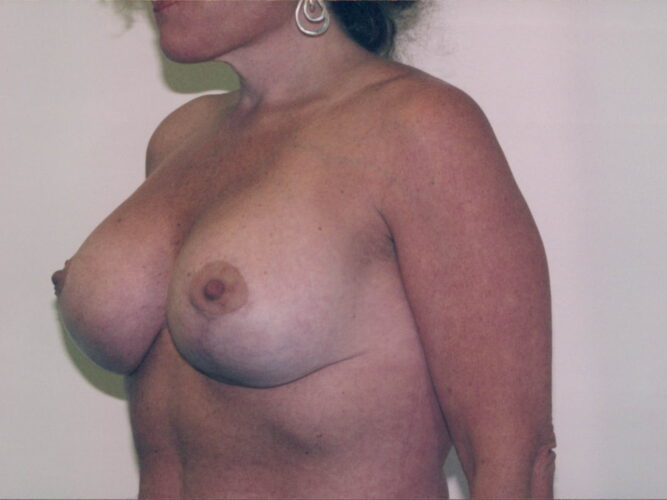 Breast Lift with Implants Patient 13 - After - 1