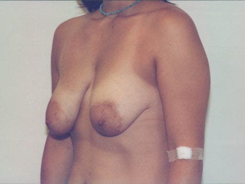breast lift implants 1 00381