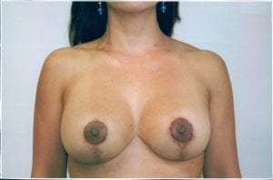 Breast Lift with Implants Patient 15 - After - 1 Thumbnail