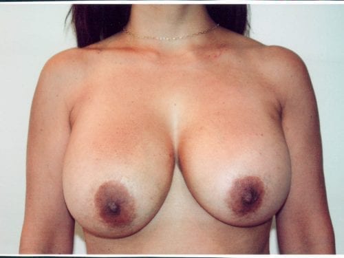 breast lift implants 1 0048