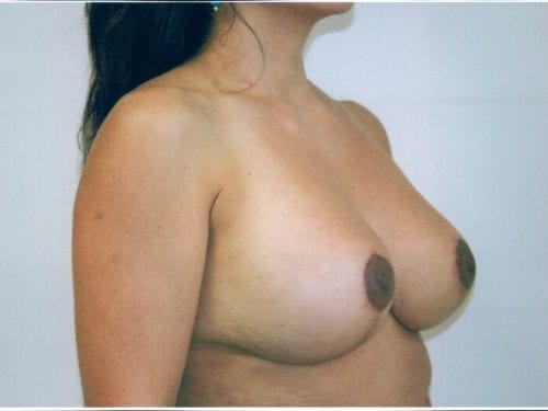 breast lift implants 1 0049