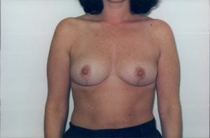 Breast Reduction Patient 09 - After - 1 Thumbnail