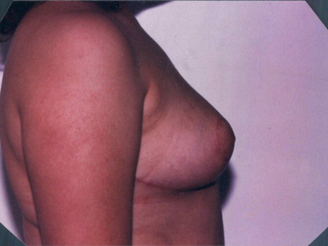 Breast Reduction Patient 07 - After - 1