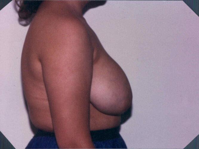 Breast Reduction Patient 07 - Before - 1