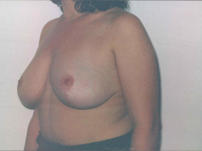 Breast Reduction Patient 06 - After - 1