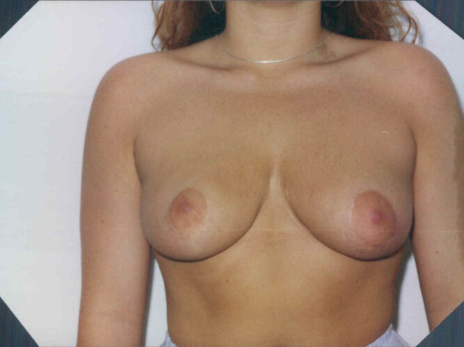 Breast Reduction Patient 05 - After - 1
