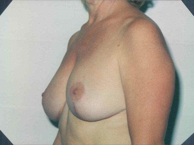 Breast Reduction Patient 04 - After - 1