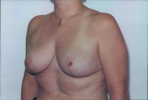 Breast Reduction Patient 03 - After - 2 Thumbnail