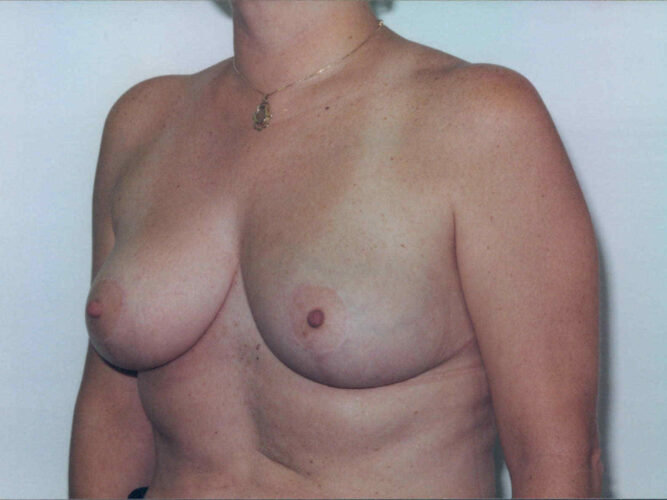 Breast Reduction Patient 03 - After - 2
