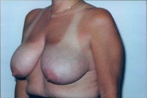 Breast Reduction Patient 03 - Before - 2 Thumbnail