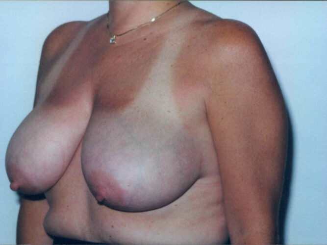 Breast Reduction Patient 03 - Before - 2