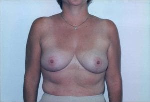 Breast Reduction Patient 03 - After - 1 Thumbnail