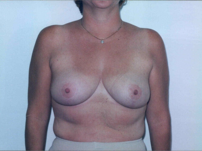 Breast Reduction Patient 03 - After - 1