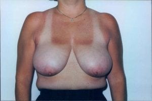 Breast Reduction Patient 03 - Before - 1 Thumbnail