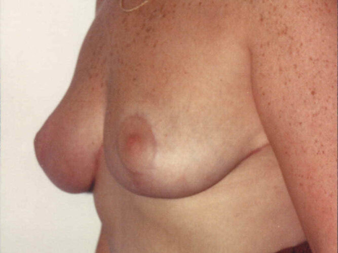 Breast Reduction Patient 01 - After - 1