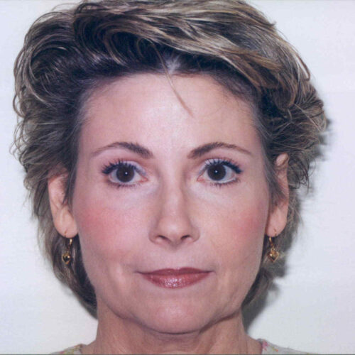 Brow Lift Patient 09 - After - 1