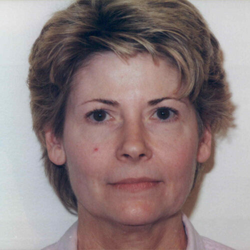 Brow Lift Patient 09 - Before - 1