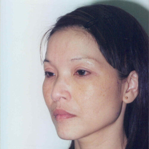 Brow Lift Patient 08 - Before - 1