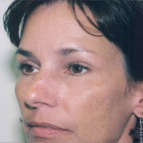 Brow Lift Patient 04 - After - 1