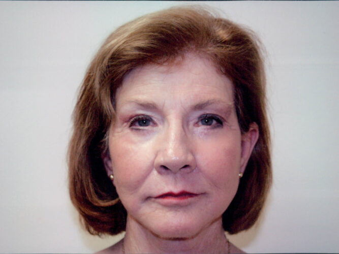 Cheek and Chin Implants Patient 01 - After - 1