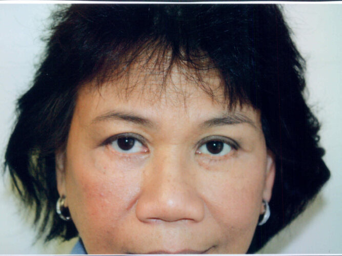 Eyelid Patient 18 - After - 1