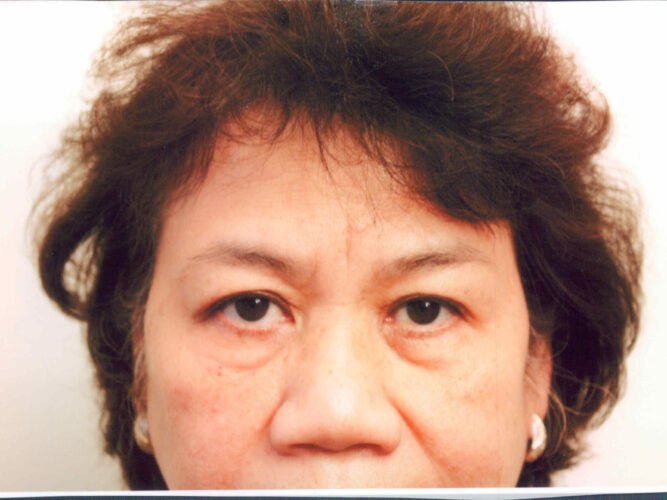Eyelid Patient 18 - Before - 1