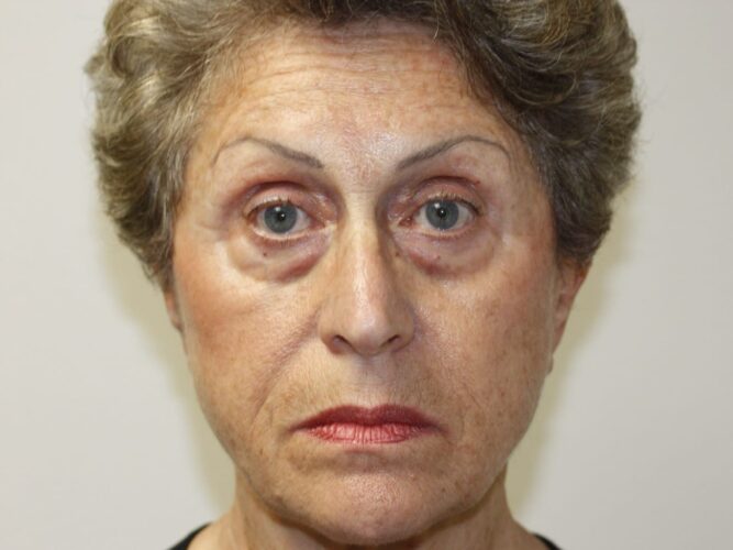 Eyelid Patient 22-2 - Before - 1