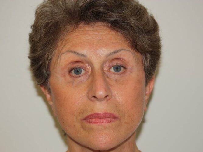 Eyelid Patient 22-2 - After - 1